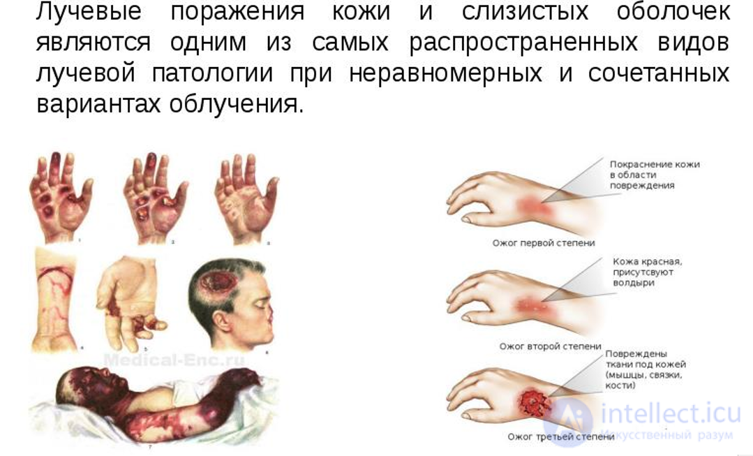 Radiation Sickness: Types, Signs and Causes