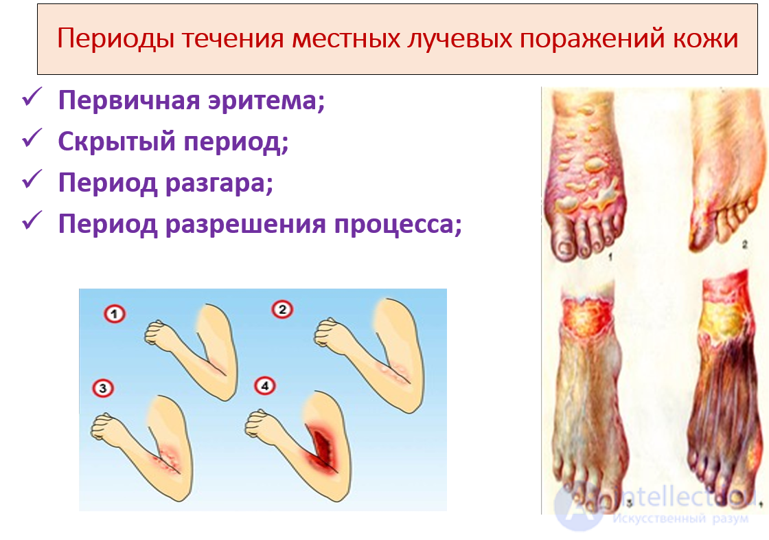 Radiation Sickness: Types, Signs and Causes