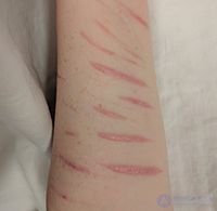 Post-Traumatic Stress Disorder (PTSD)