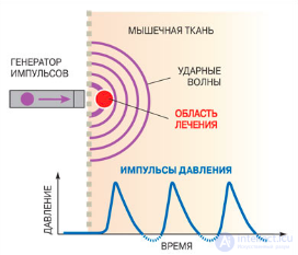 Shock wave therapy devices and their principle of operation